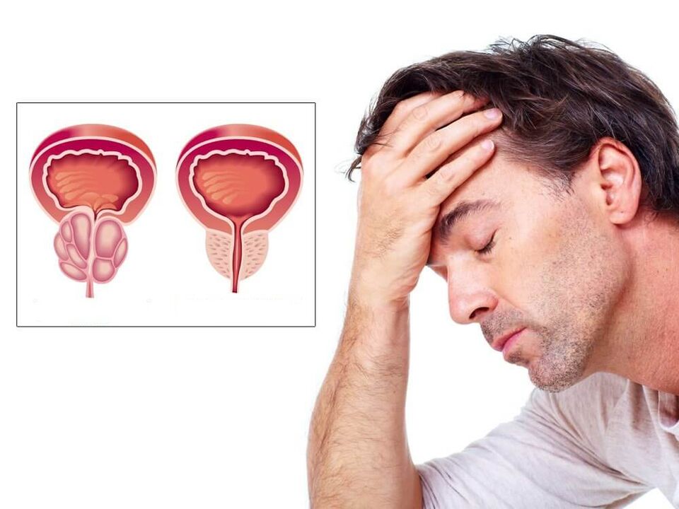symptômes de la prostatite chez les hommes