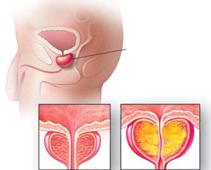 Localisation de la prostate, prostate normale et hypertrophiée dans la prostatite chronique. 