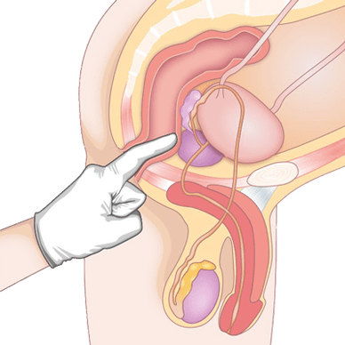 Détermination de l'état de la prostate par palpation pour le diagnostic de prostatite. 