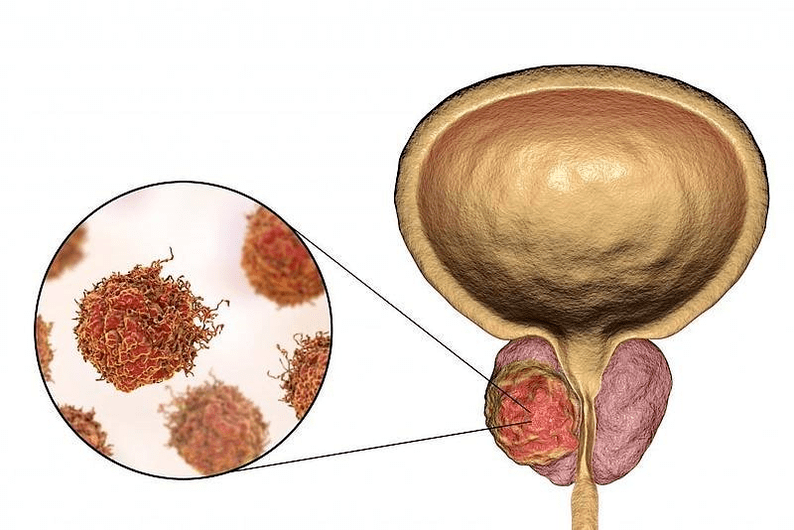 À quoi ressemblent les lésions de la prostate