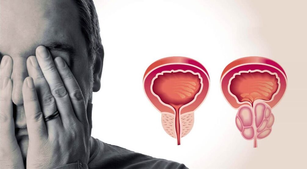 Prostate saine et enflammée